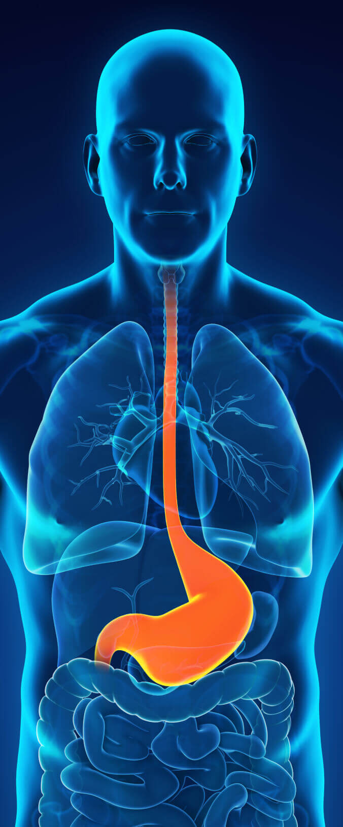acid reflux